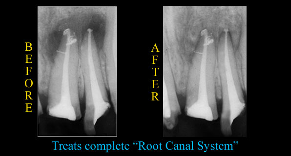 Rationale for Advanced Endodontic