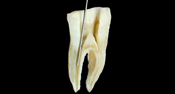 3D Cleaning of Root Canal System