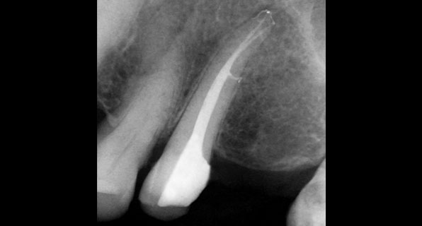 3D Cleaning of Root Canal System