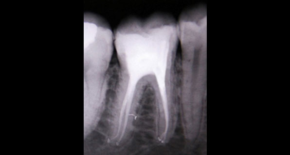 3D Obturation of Root Canal System