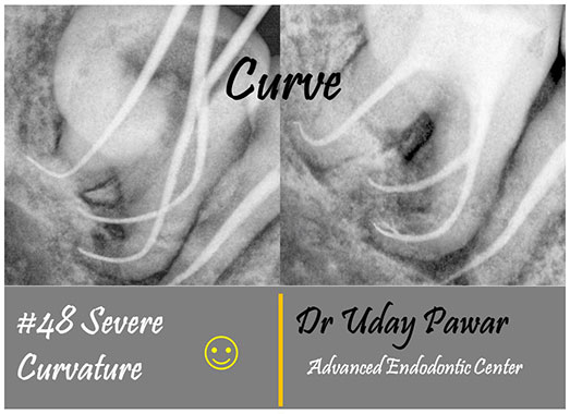 Clinical Cases Curveture