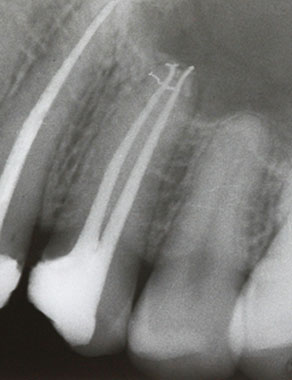 Clinical Cases Premolar