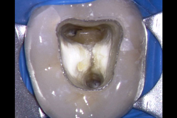 advanced endodontics courses, advanced root canal courses